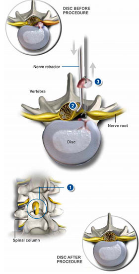Lumbar Disc Microsurgery