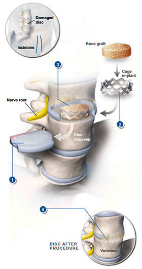 Anterior Lumbar Interbody Fusion
