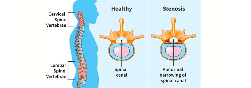 Lumbar Canal Stenosis